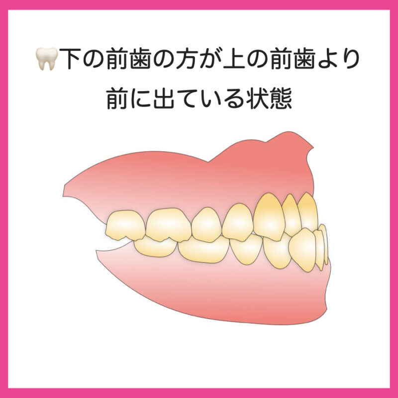 歯列矯正をしたほうがいい 歯医者が矯正治療を勧める悪い歯並び５選 Hahahablog